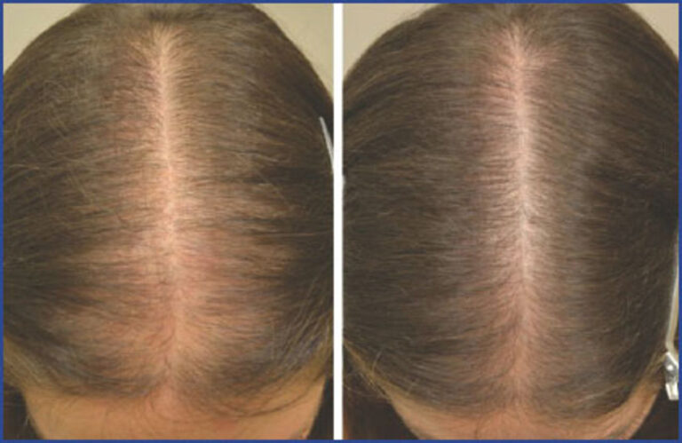 Exploring the Possibilities: Hair Transplants for Women