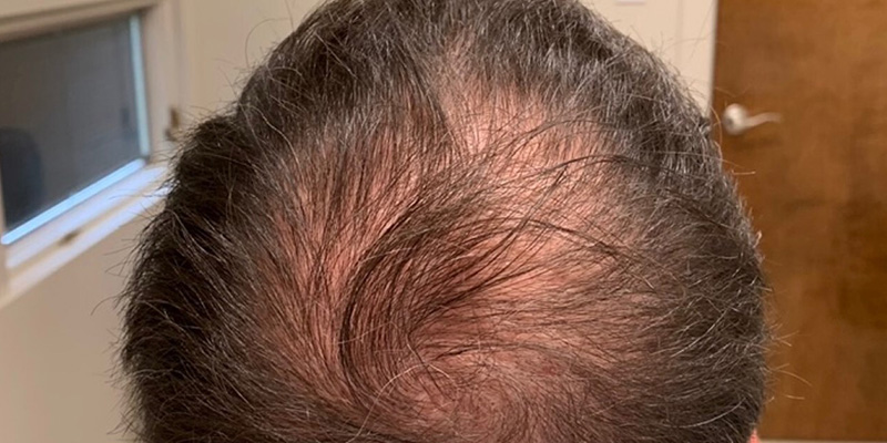 Benefits of PRP Injections for Hair Loss