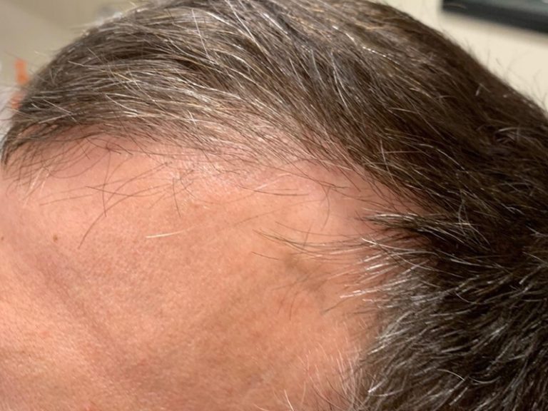 Benefits of PRP Injections for Hair Loss
