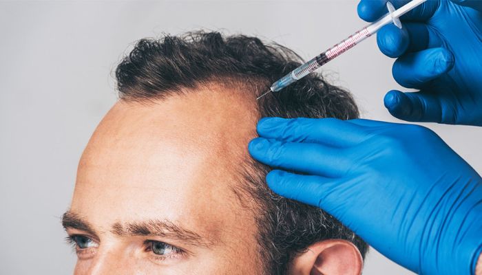 Nonsurgical Treatments for Hair Loss
