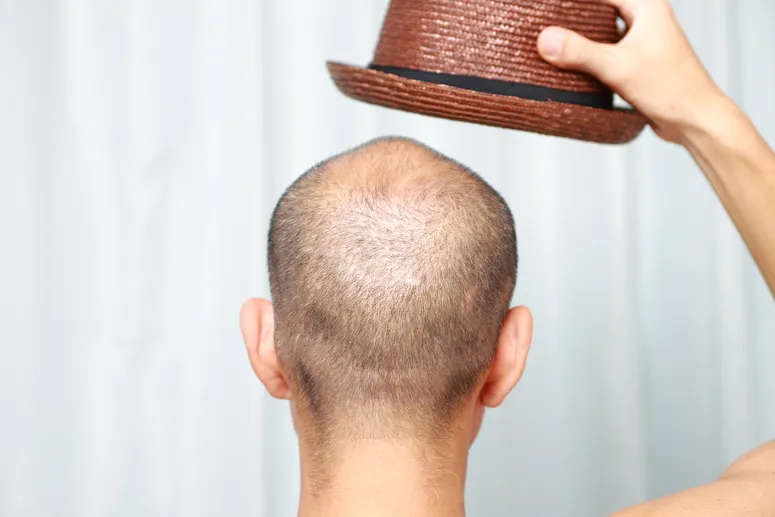 Hats and Hair Loss
