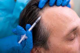 Nonsurgical Treatments for Hair Loss