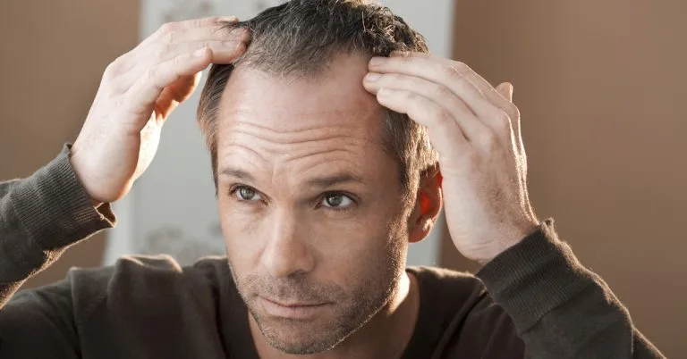 Time To Consider a Hair Transplant