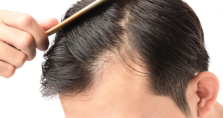 Preventing Hair Loss