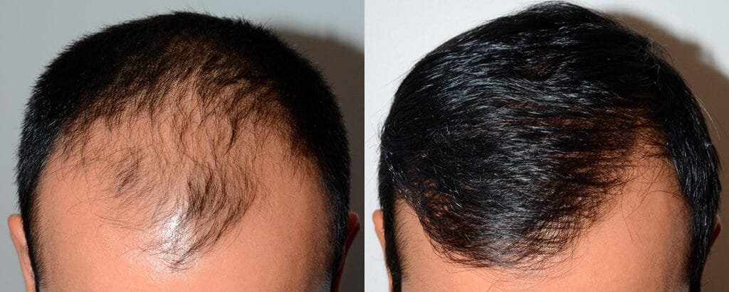 Aer Hair Transplants Permanent