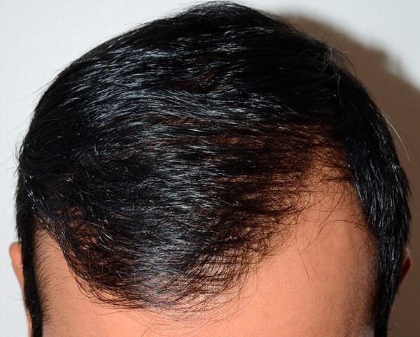 Are Hair Transplants Permanent? Get The Clear Answer