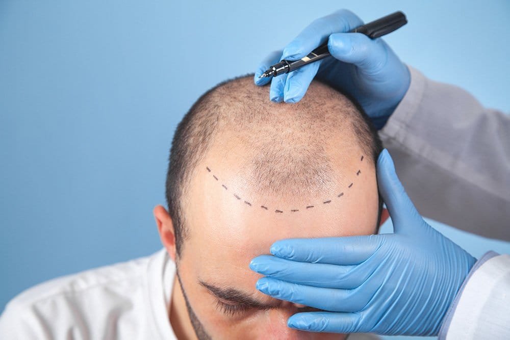 Are Hair Transplants Painful