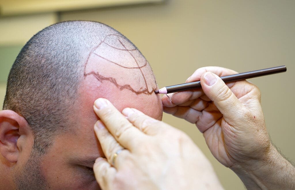 Hair Transplant Techniques