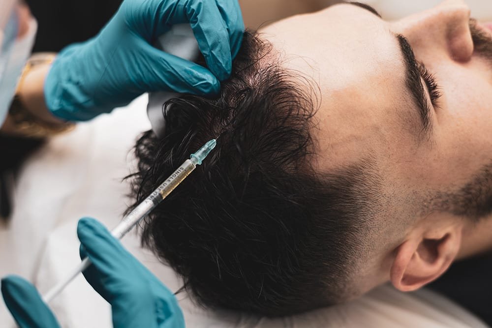 PRP Hair Therapy