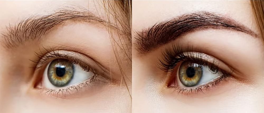 Eyebrow Transplant